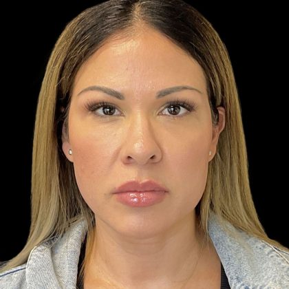 Sculptra Before & After Patient #10356