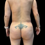 Brazilian Butt Lift Before & After Patient #10471