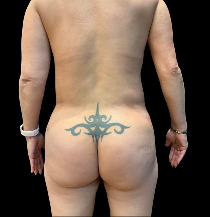 Brazilian Butt Lift Before & After Patient #10471