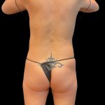 Brazilian Butt Lift Before & After Patient #10471