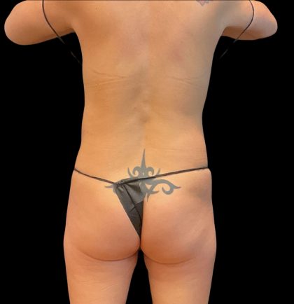 Brazilian Butt Lift Before & After Patient #10471