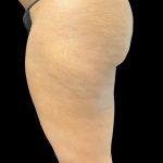 Aveli (Cellulite Removal) Before & After Patient #10476