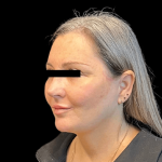 Brow Lift Before & After Patient #10440