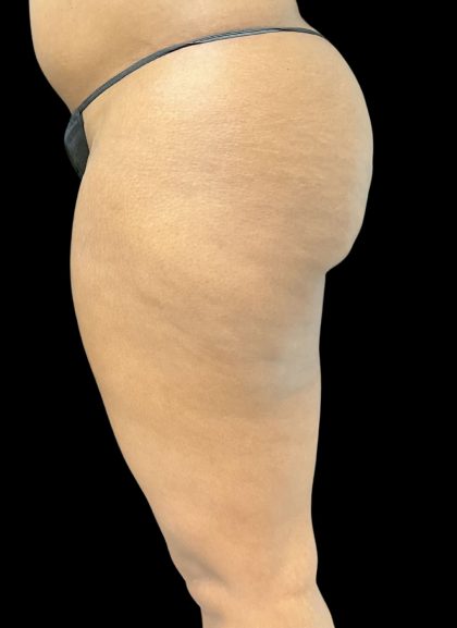 Aveli (Cellulite Removal) Before & After Patient #10476
