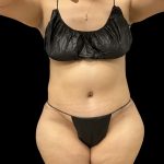 Tummy Tuck Before & After Patient #10490