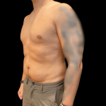 High Definition Liposuction Before & After Patient #10447