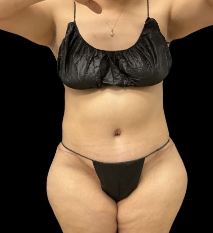 Tummy Tuck Before & After Patient #10490