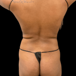 Rib Repositioning Before & After Patient #10487