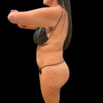 Brazilian Butt Lift Before & After Patient #10323