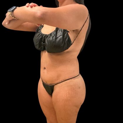 Brazilian Butt Lift Before & After Patient #10323