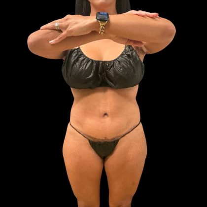 Brazilian Butt Lift Before & After Patient #10323