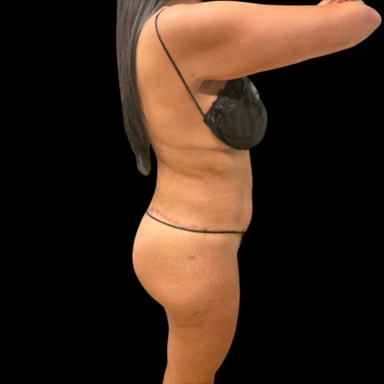 Brazilian Butt Lift Before & After Patient #10323