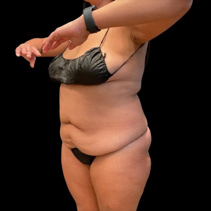 Brazilian Butt Lift Before & After Patient #10323
