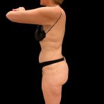 Brazilian Butt Lift Before & After Patient #10291