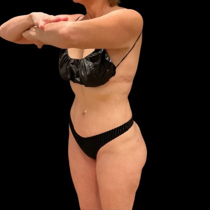Brazilian Butt Lift Before & After Patient #10291