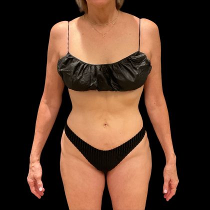 Brazilian Butt Lift Before & After Patient #10291