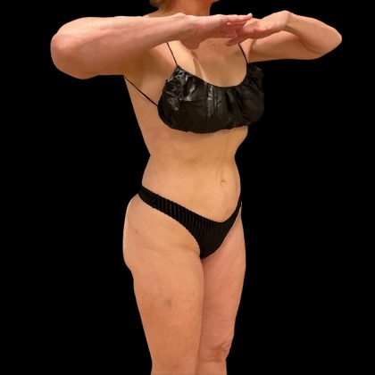 Brazilian Butt Lift Before & After Patient #10291