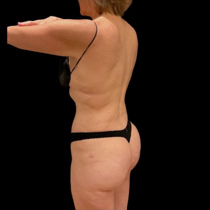 Brazilian Butt Lift Before & After Patient #10291