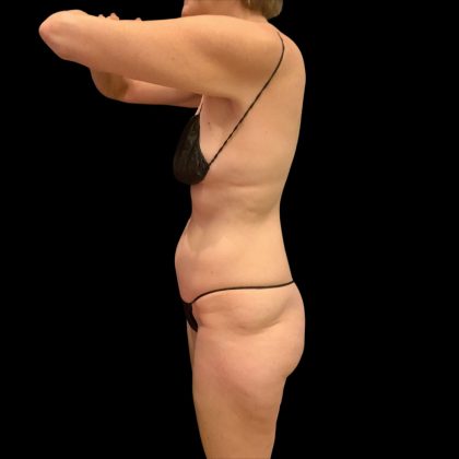 Brazilian Butt Lift Before & After Patient #10291