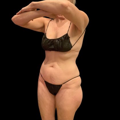 Brazilian Butt Lift Before & After Patient #10291