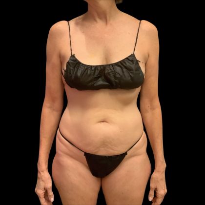 Brazilian Butt Lift Before & After Patient #10291