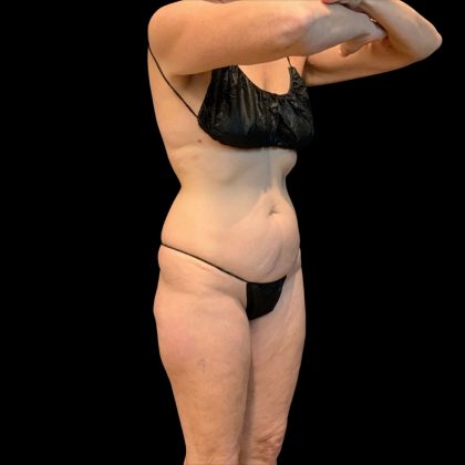 Brazilian Butt Lift Before & After Patient #10291