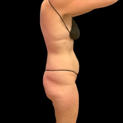 Brazilian Butt Lift Before & After Patient #10291