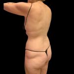 Brazilian Butt Lift Before & After Patient #10291