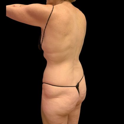 Brazilian Butt Lift Before & After Patient #10291