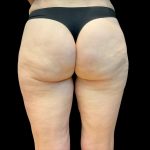 Morpheus8 Before & After Patient #10380