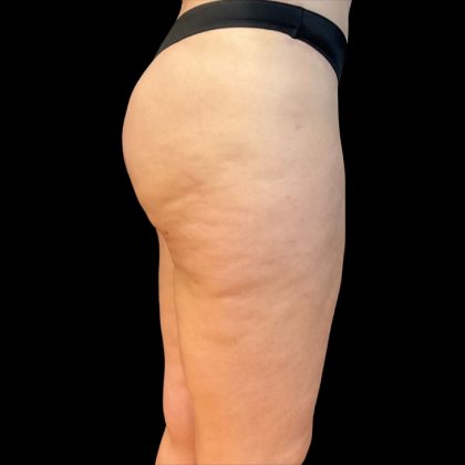 Morpheus8 Before & After Patient #10380