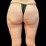 Morpheus8 Before & After Patient #10380