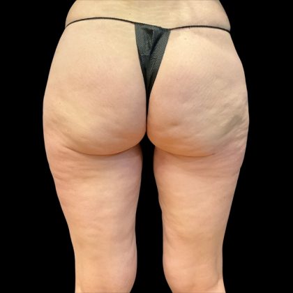 Morpheus8 Before & After Patient #10380