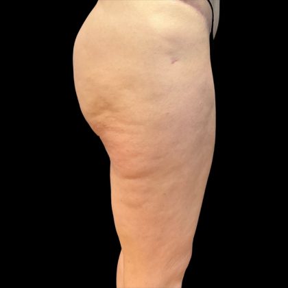 Morpheus8 Before & After Patient #10380
