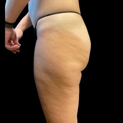 Morpheus8 Before & After Patient #10343