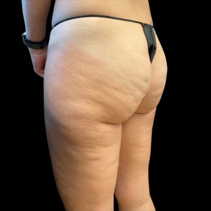 Morpheus8 Before & After Patient #10343