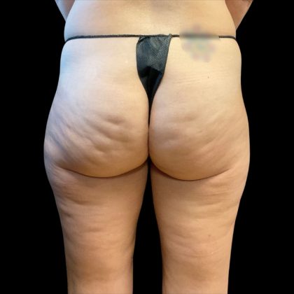 Morpheus8 Before & After Patient #10343