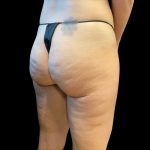 Morpheus8 Before & After Patient #10343