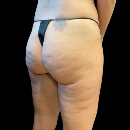 Morpheus8 Before & After Patient #10343