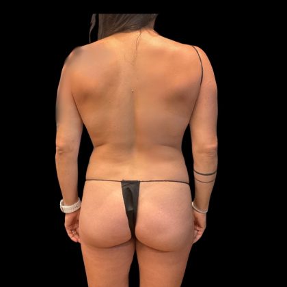 High Definition Liposuction Before & After Patient #10554