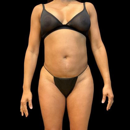 Brazilian Butt Lift Before & After Patient #10807
