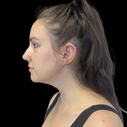 Liquid Rhinoplasty Before & After Patient #10809