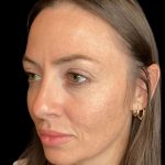 Sculptra Before & After Patient #10808