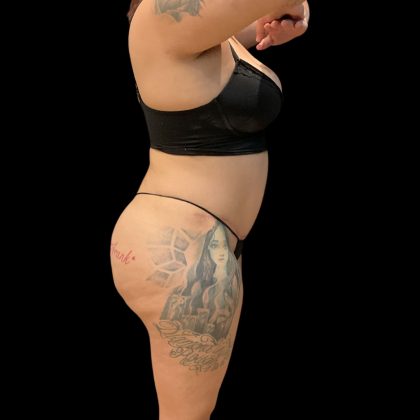Brazilian Butt Lift Before & After Patient #10722
