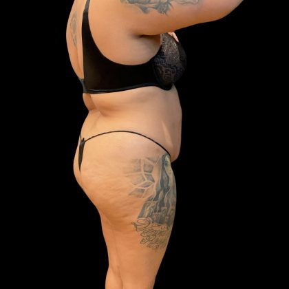 Brazilian Butt Lift Before & After Patient #10722