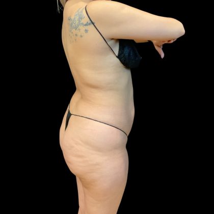 Brazilian Butt Lift Before & After Patient #10718