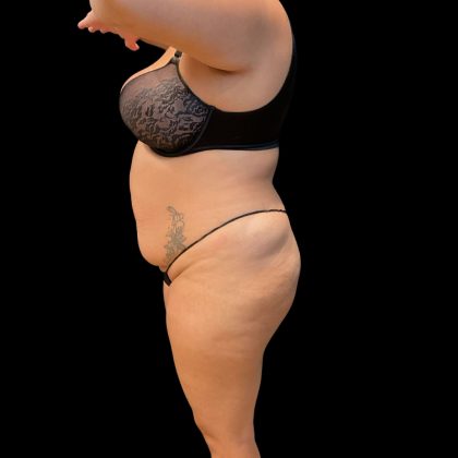 Brazilian Butt Lift Before & After Patient #10722