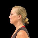 Facelift Before & After Patient #10717