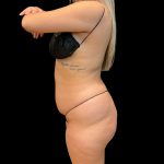 Brazilian Butt Lift Before & After Patient #10718