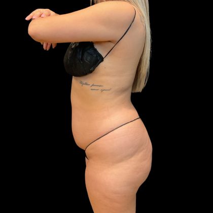 Brazilian Butt Lift Before & After Patient #10718